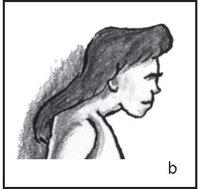 head-forward-posture